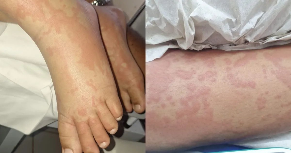 Exame descarta contaminação por detergente em criança internada no RN