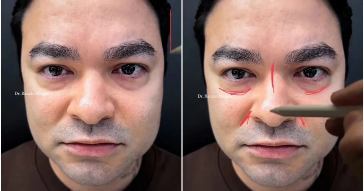 Aos 34 anos, Yudi Tamashiro faz harmonização facial; veja antes e depois